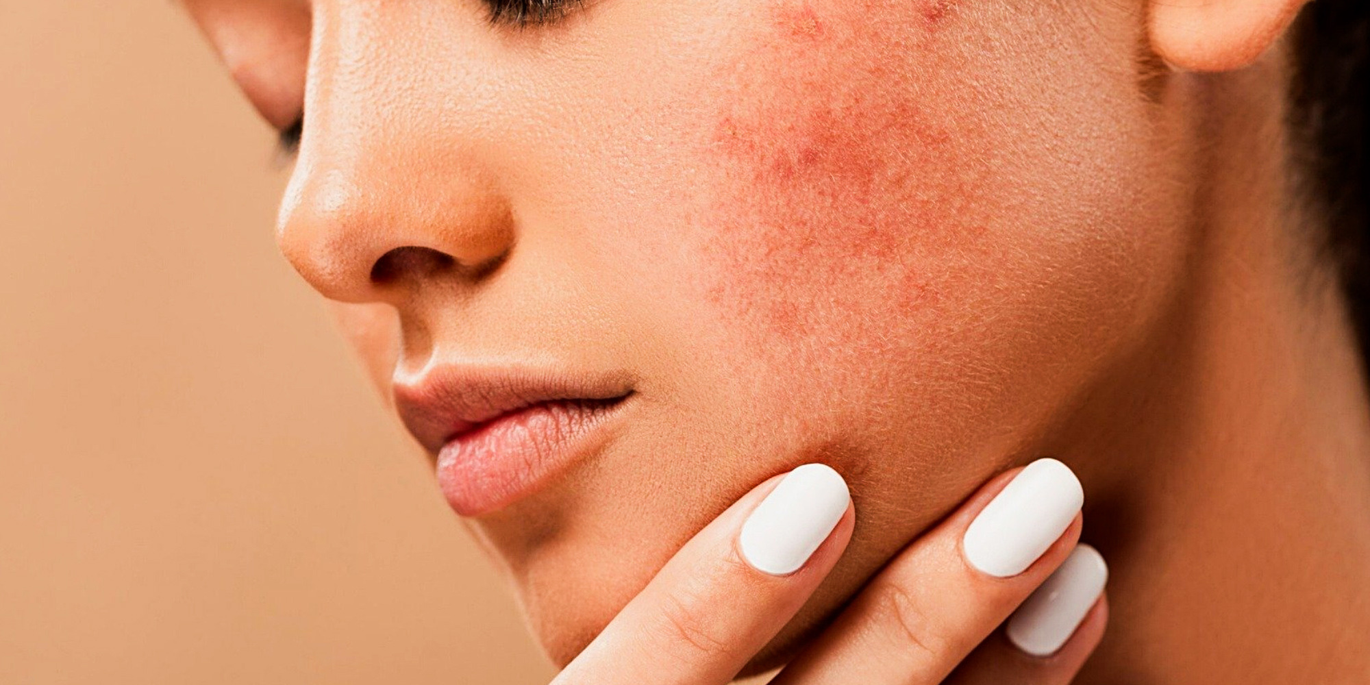 Stop using tretinoin and consult a doctor if skin irritation