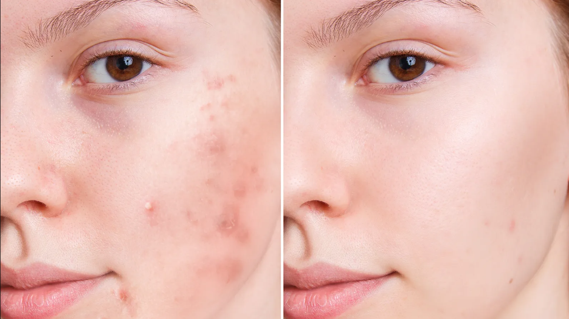 Tretinoin is the treatment of acne and sun-damaged skin