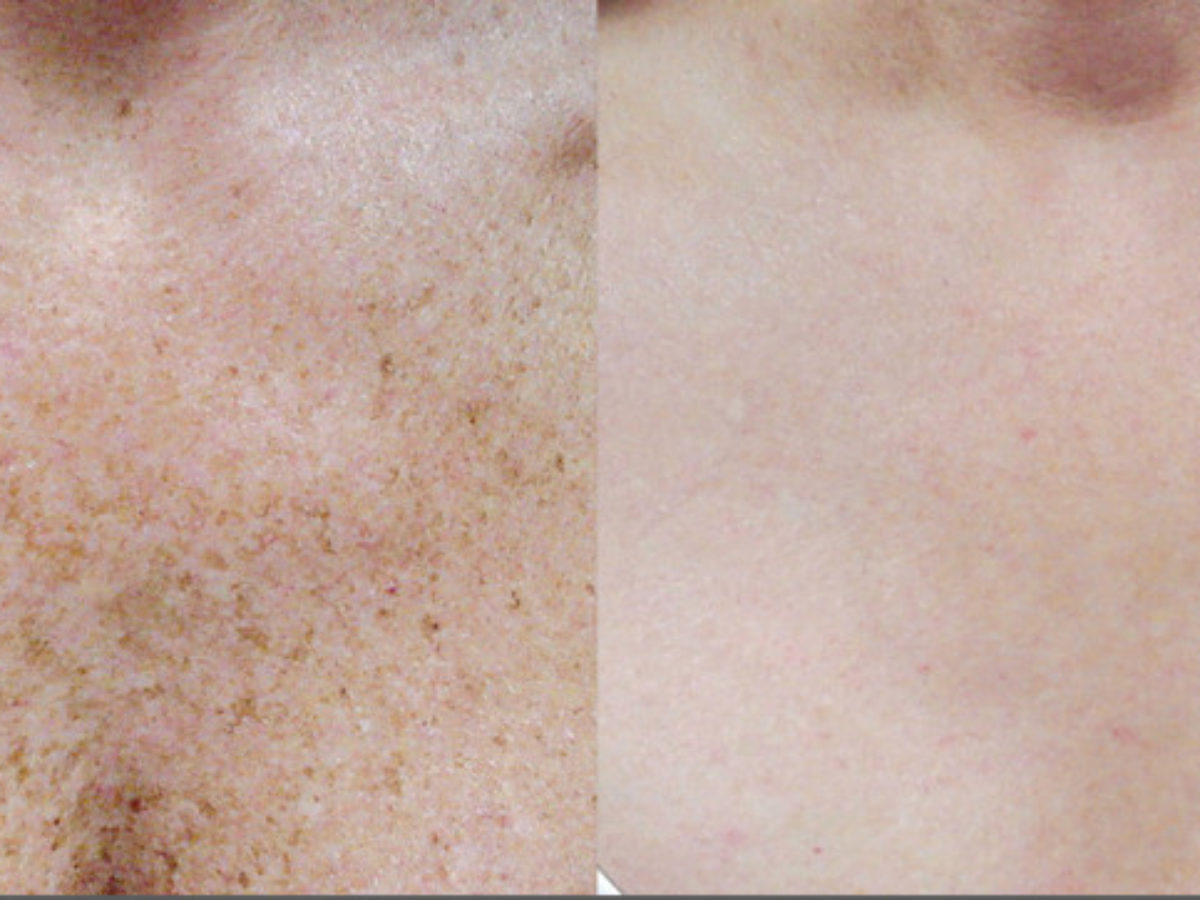 Laser is the fastest way of freckle removal 