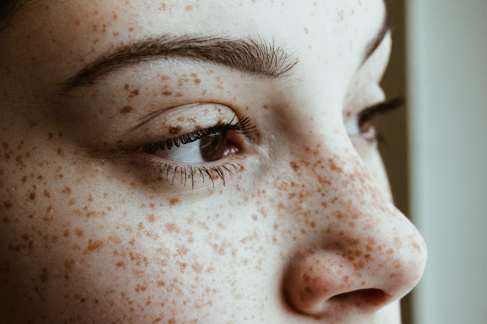 Freckles are patches of excess color or hyperpigmentation under your skin | How to treat freckles