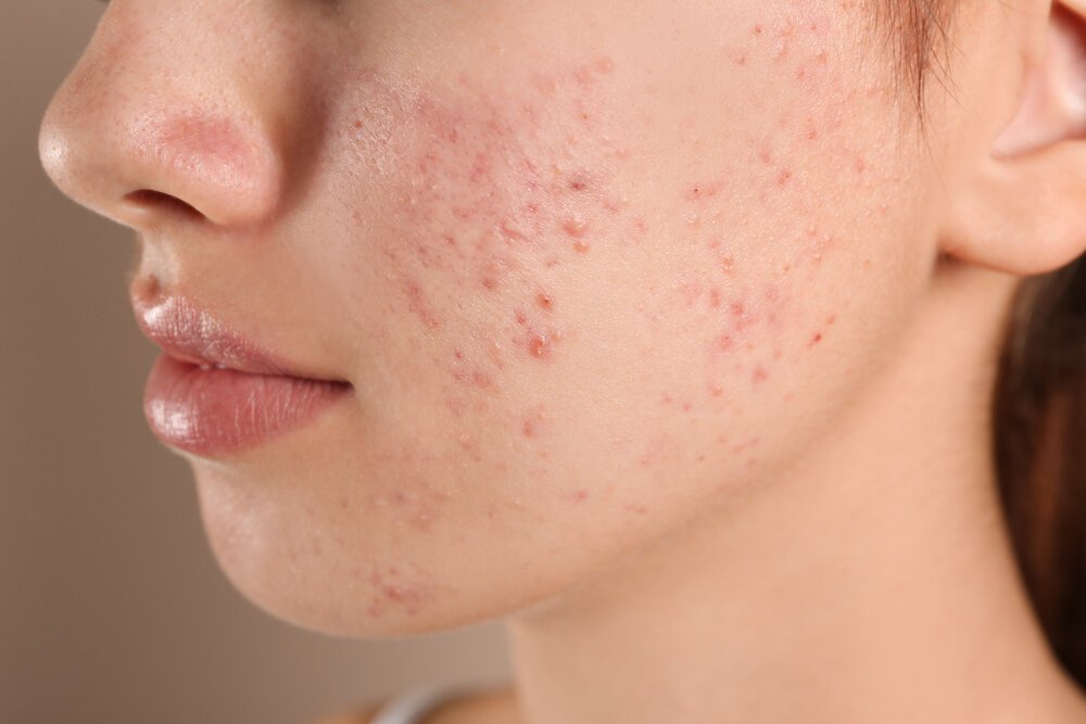 Some products that have comedogenic ingredients can lead to acne